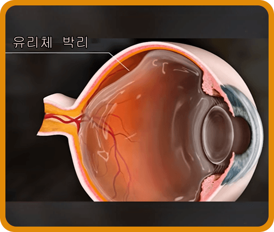 눈 검은것이떠다니는것