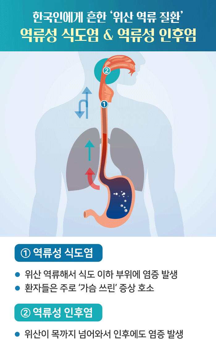 역류성 식도염 목 이물감, 가래가 낀 것처럼 느껴지는 이유