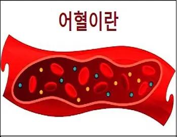 어혈이란