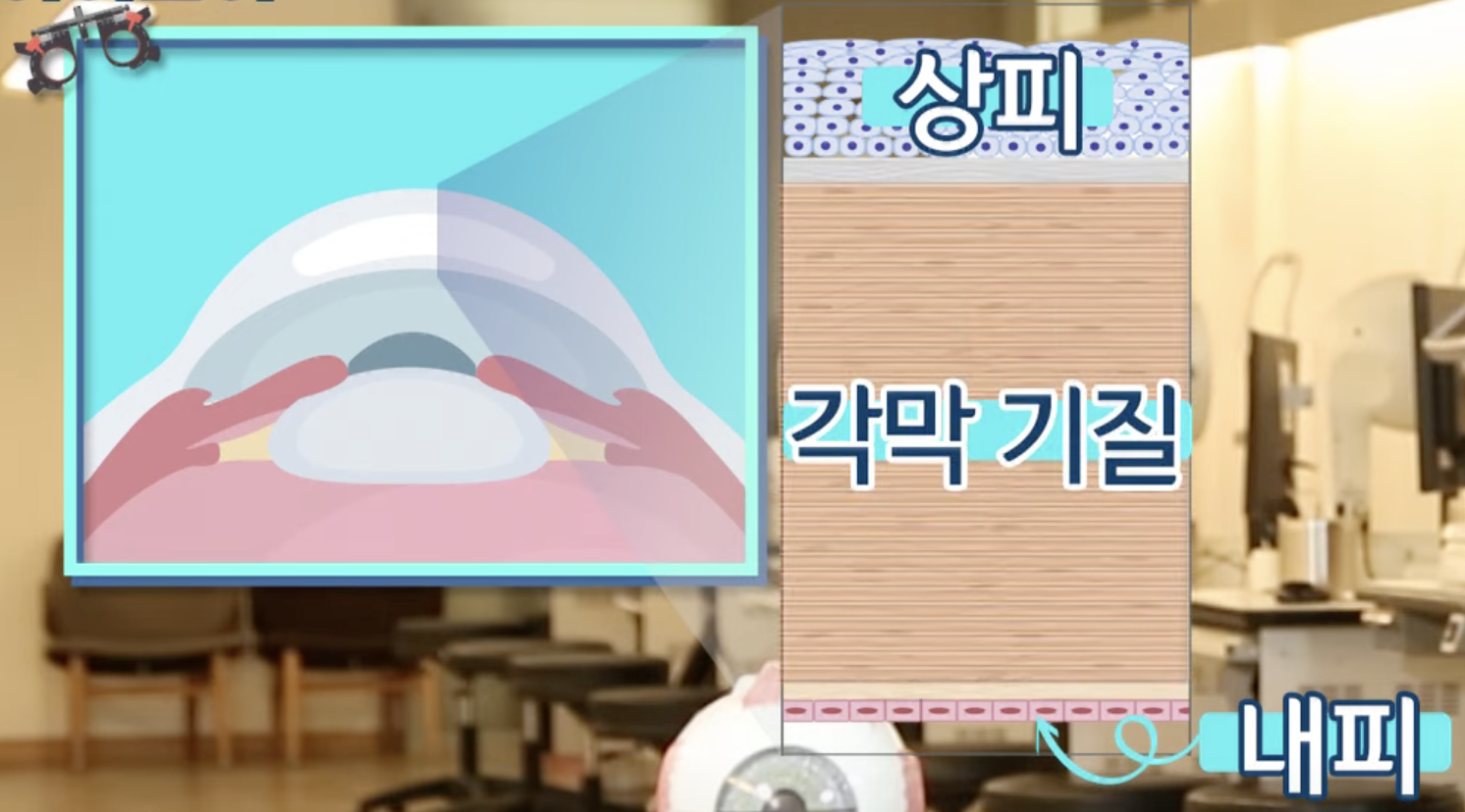 시력교정술 종류 라섹 라식 스마일 장단점 비교