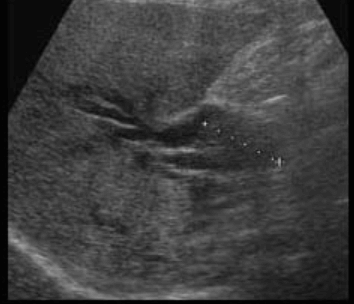 간내담관암(intrahepatic cholagiocarcinoma)