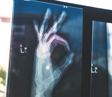 골다공증에 좋은 음식 예방 식단