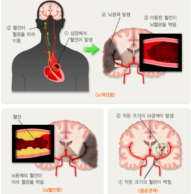 허혈성 뇌졸증 출처 hi.njic.co.kr