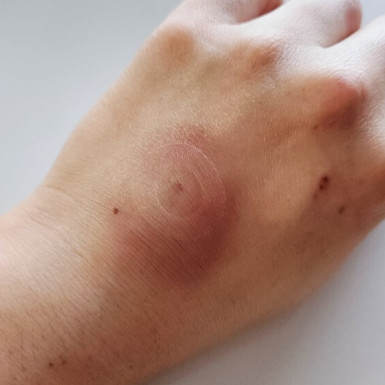 주사-손등-부어오름