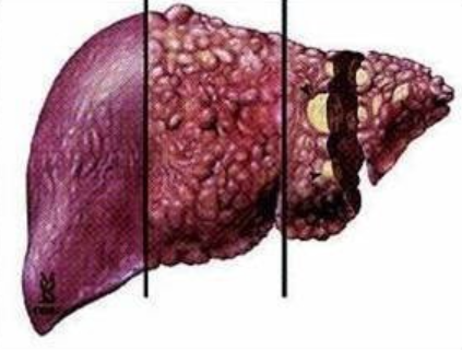 간경변에서 간암으로 진행되는 간