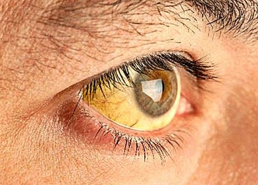 빌리루빈-정상수치