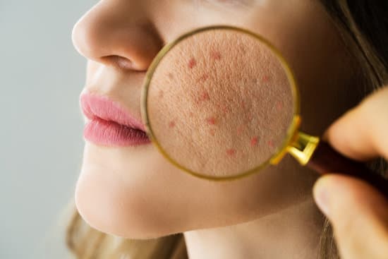 벤조일 퍼옥사이드(Benzoyl Peroxide): 여드름 치료의 핵심 성분