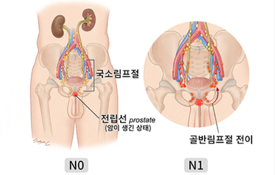 전립선암의 N병기 그림