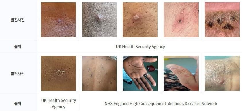 엠폭스(원숭이두창)-발진사진