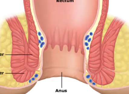 치질-증상-자가치료법-건강