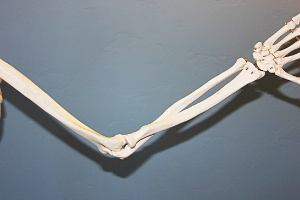 류머티스관절염-이미지