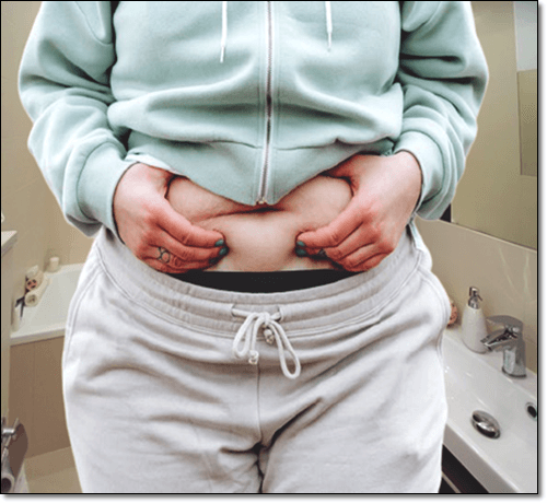 비만 여성 분환기 장애