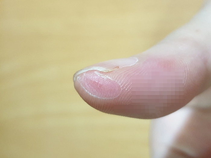 양배추-채칼에-베인-손가락