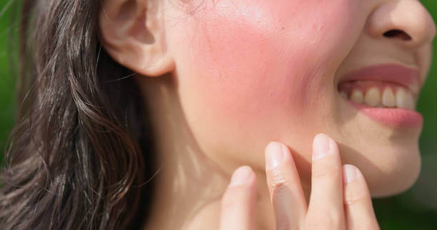 수원 안면홍조 주사 치료, 부작용 없이 안전할까?