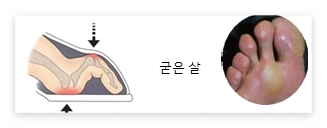 굳은살 예시 사진
