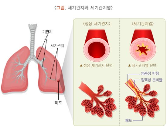 세기관지와 세기관지염