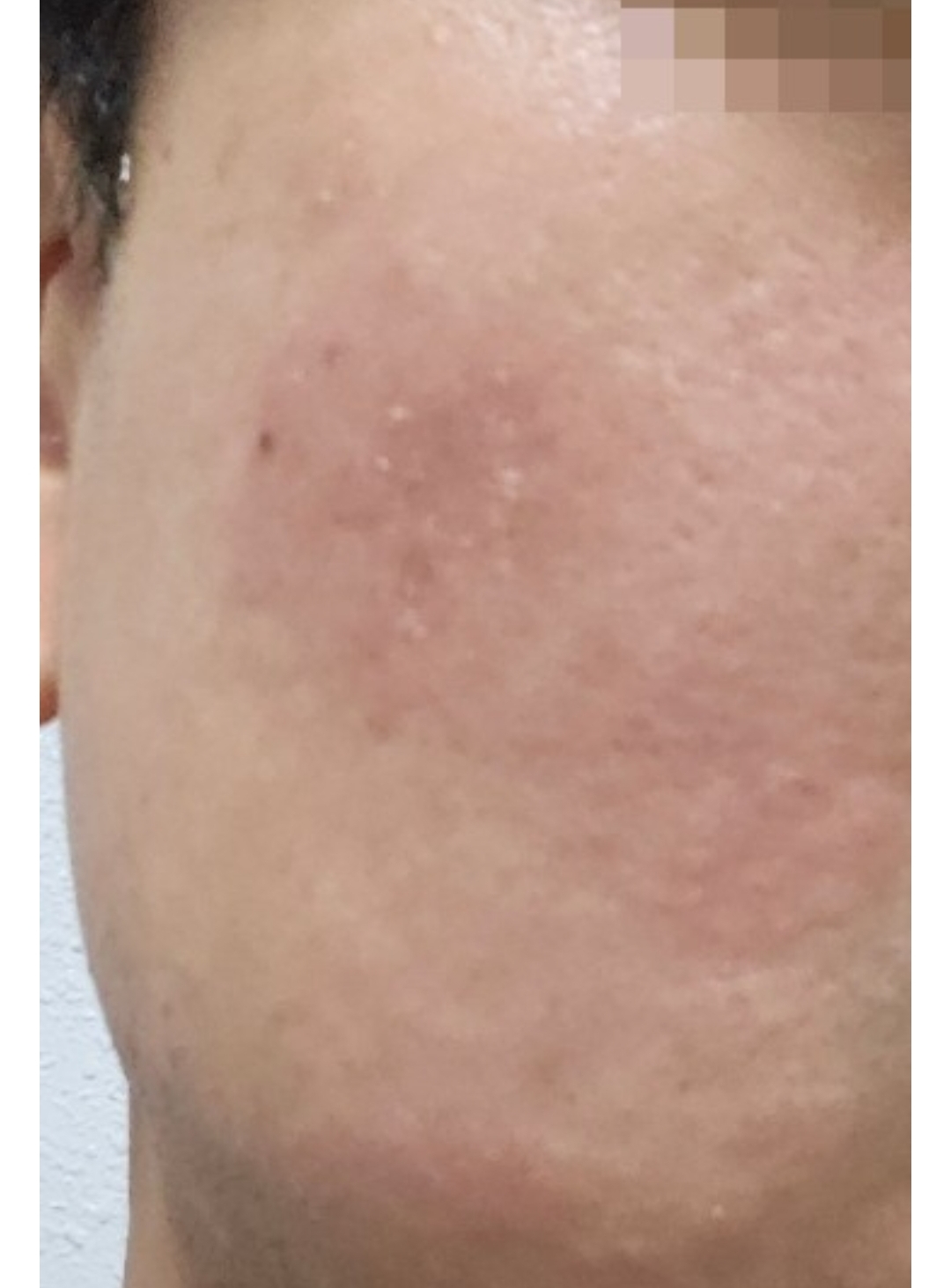 운동 후/더위 먹은 후 얼굴이 벌개지고 부을 때(김피부과)