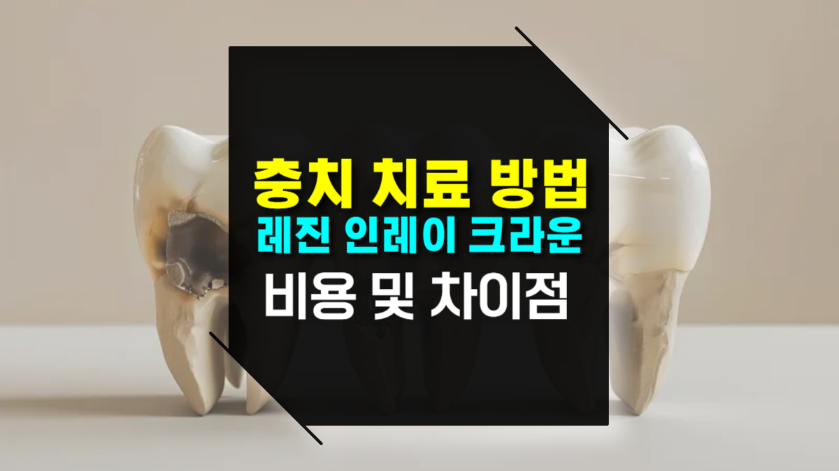 치과 충치 치료 방법 : 레진, 인레이, 크라운 비용 및 차이점