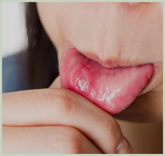 입안 물혹 원인, 치료