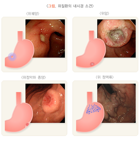 위내시경 검사