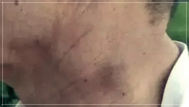 호지킨림프종과 비호지킨림프종: 이해&#44; 진단&#44; 그리고 치료