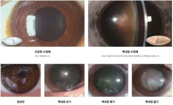 백내장 수술 비용 실비 보험 청구 회복기간_12