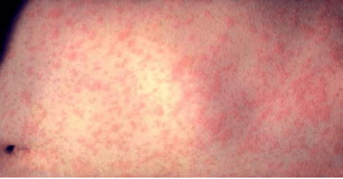 홍역 증상 (홍역과 수두 차이점)