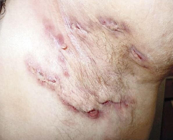 화농성 한선염 증상