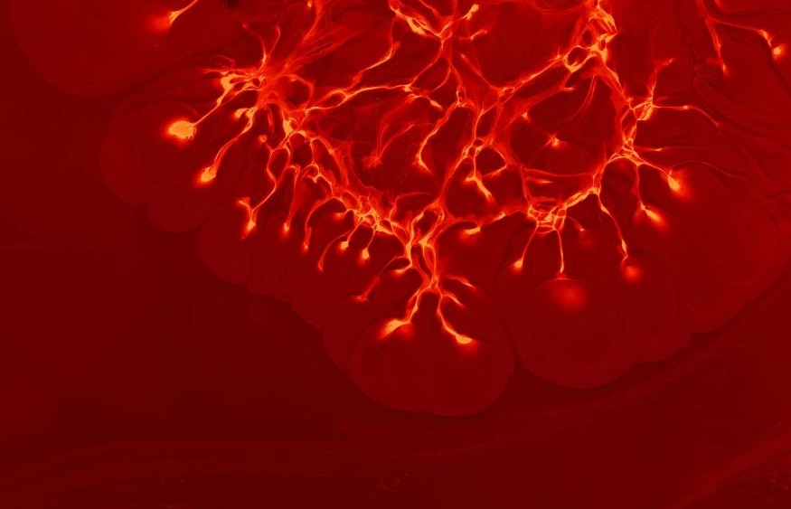 경동맥 협착증 치료