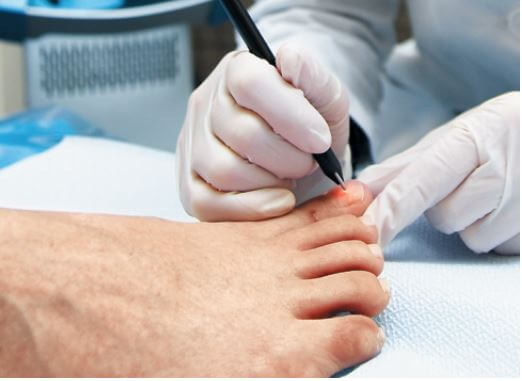 발톱 무좀 레이저 치료