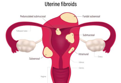 자궁근종 증상 7가지, 수술후 회복기간