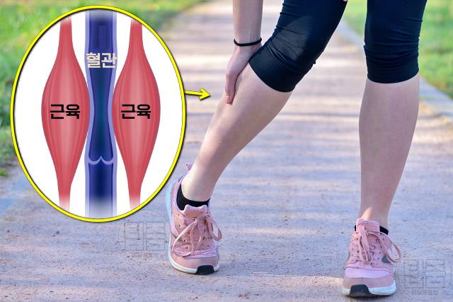 종아리 통증 원인 종아리가 땡기고 아파요 만성 구획증후군