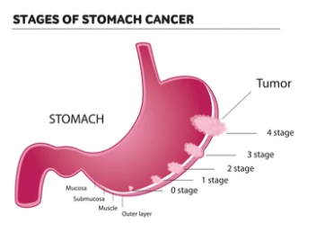 위암 수술 후 먹지말아야 할 음식
