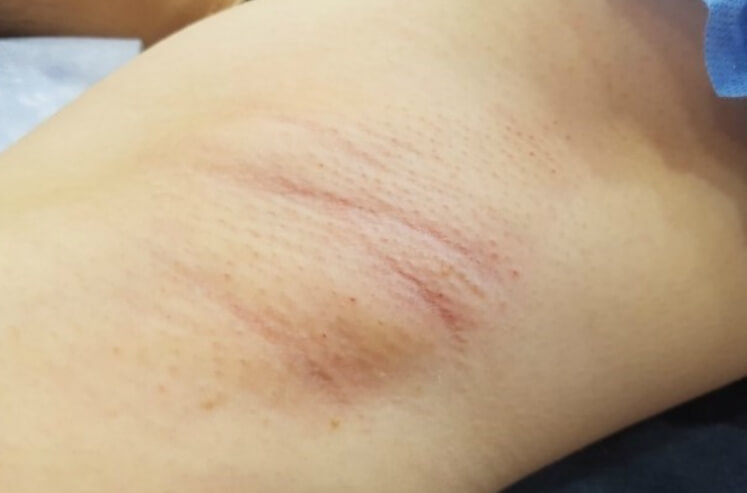 겨드랑이 모공각화증