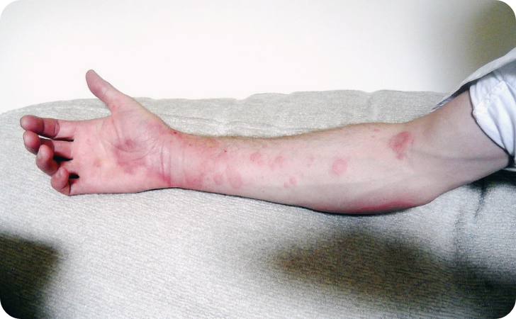 더마톱연고-효능-부작용