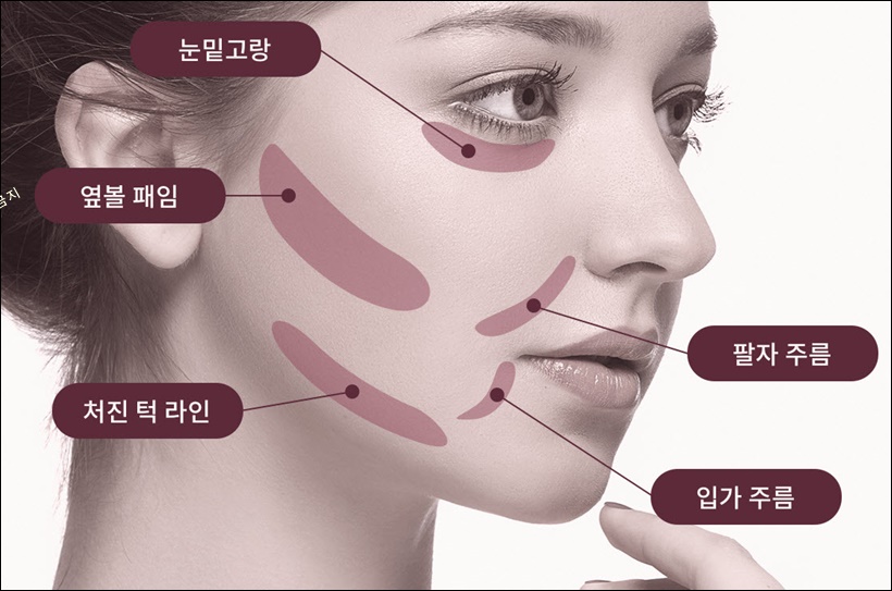 팔자주름 실리프팅