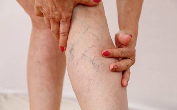 하지 정맥류 초기증상과 베나실 발거술 등의 치료방법 장단점