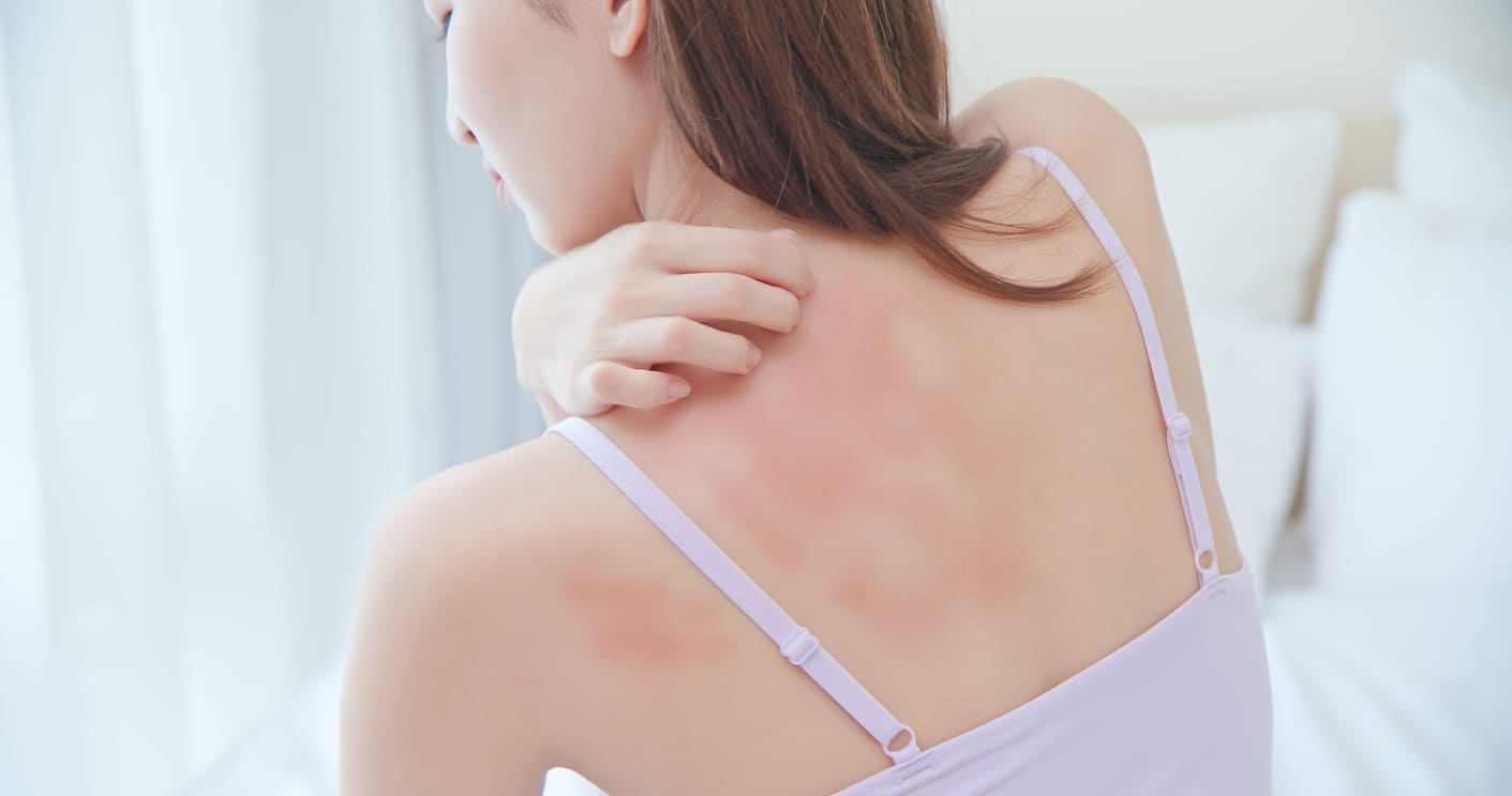 한포진 습진 증상