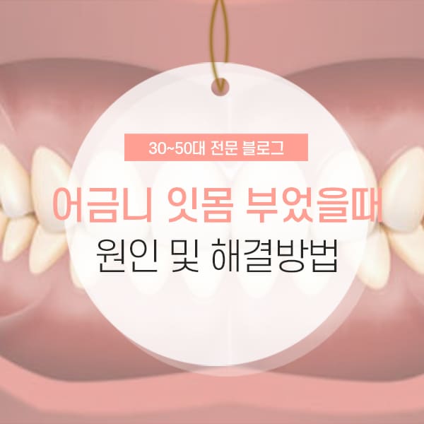 어금니 잇몸이 부었을 때 증상 및 해결방법 소개