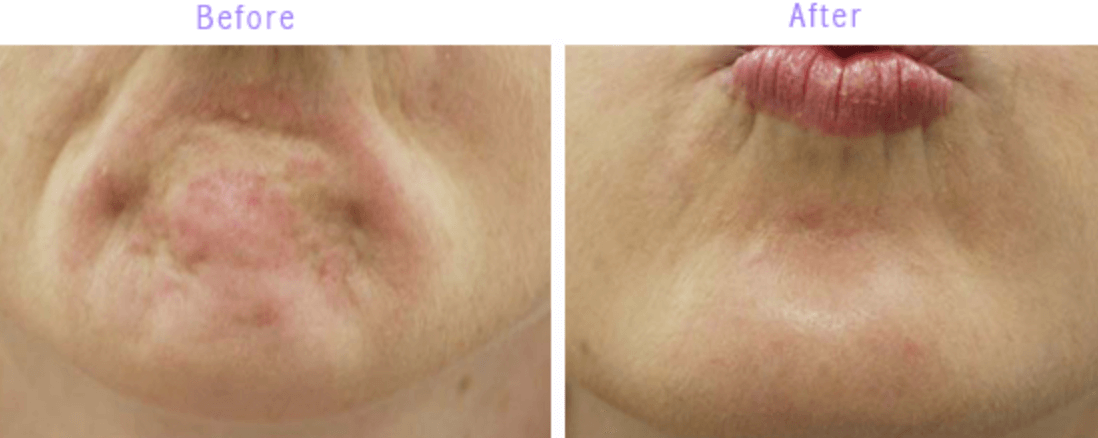 자갈턱 보톡스 효과