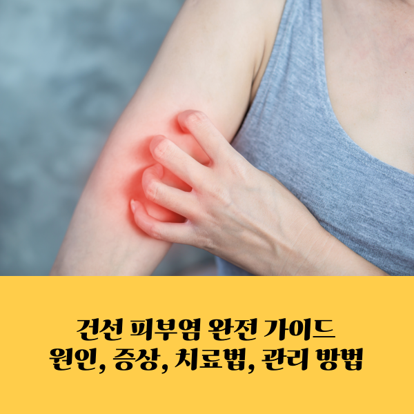 건선 피부염 완전 가이드 원인, 증상, 치료법, 관리 방법
