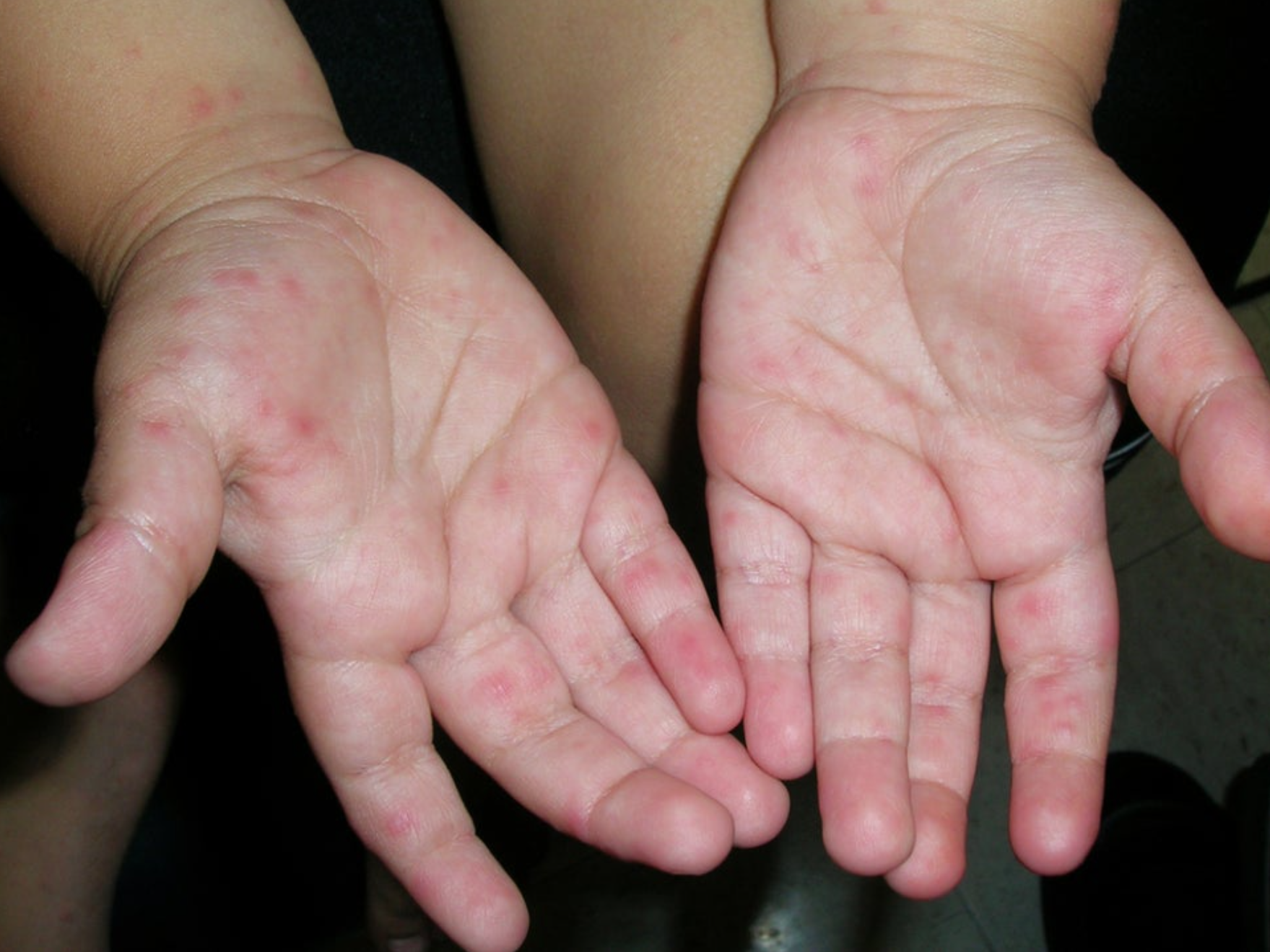 수족구병 잠복기