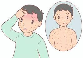 홍역 회복에 좋은 음식은 어떤것이 있을까