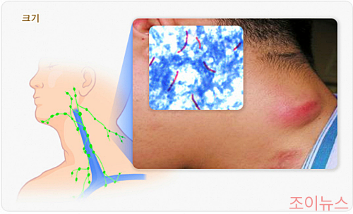목 부음과 림프절염의 주요 원인_이미지출처: 국가건강정보포털