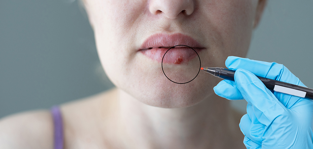 대상포진 신경통