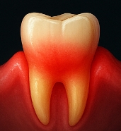 잇몸이 붓고 아플 때