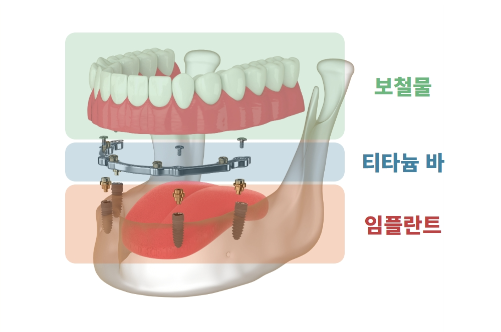 임플란트 가격 비교 사이트 안내