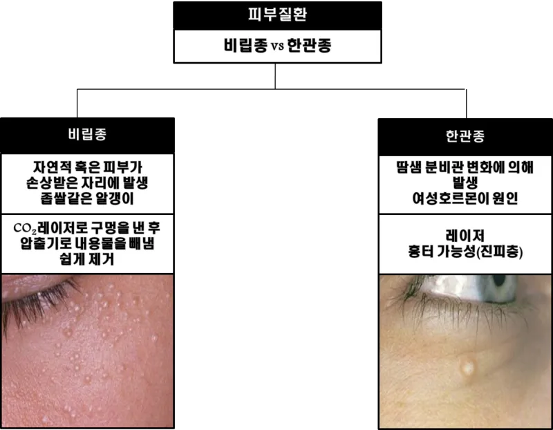 비립종 생기는 이유 비립종 없애는 방법 피부 관리법_4