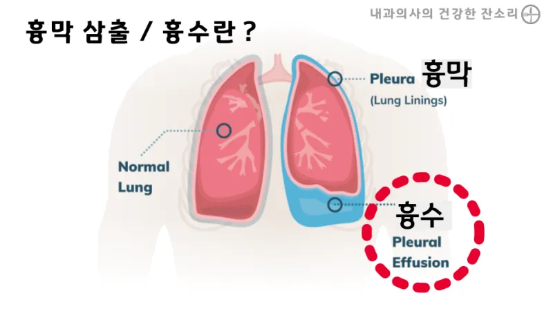 폐에 물이 차는 원인 증상 물참 관리 포인트에 대한 건강정보_3