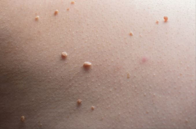 목에 있는 쥐젖의 모습